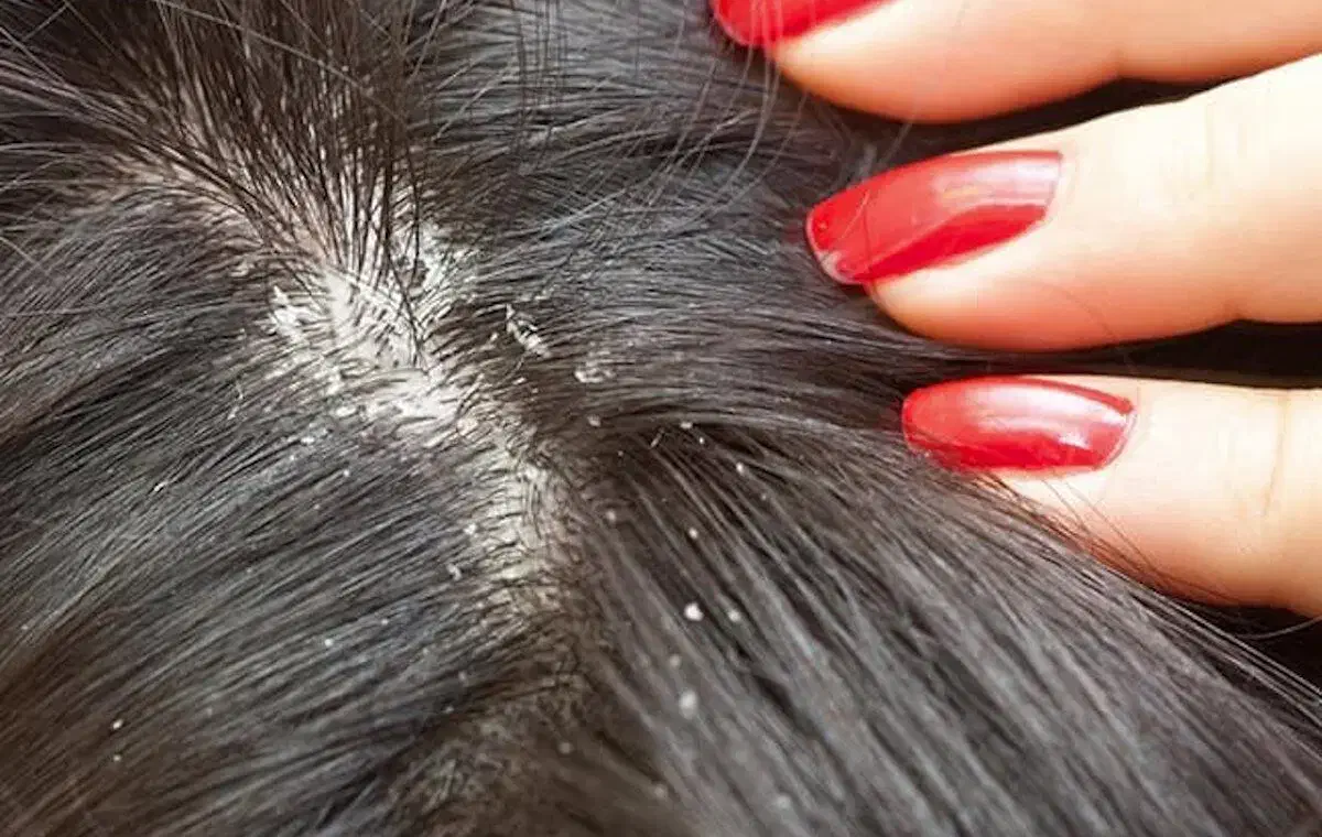 درمان رشک و شپش|آرایشی، بهداشتی، درمانی|گلبهار, شهر جدید گلبهار|دیوار