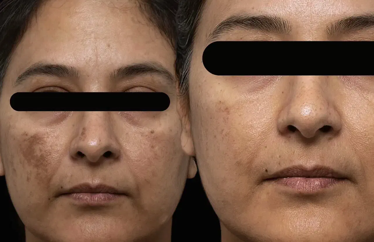 لیزر موهای زائد الکس پلاس (شاتی) بدون ژل/درمان لک|خدمات آرایشگری و زیبایی|رشت, گلسار|دیوار