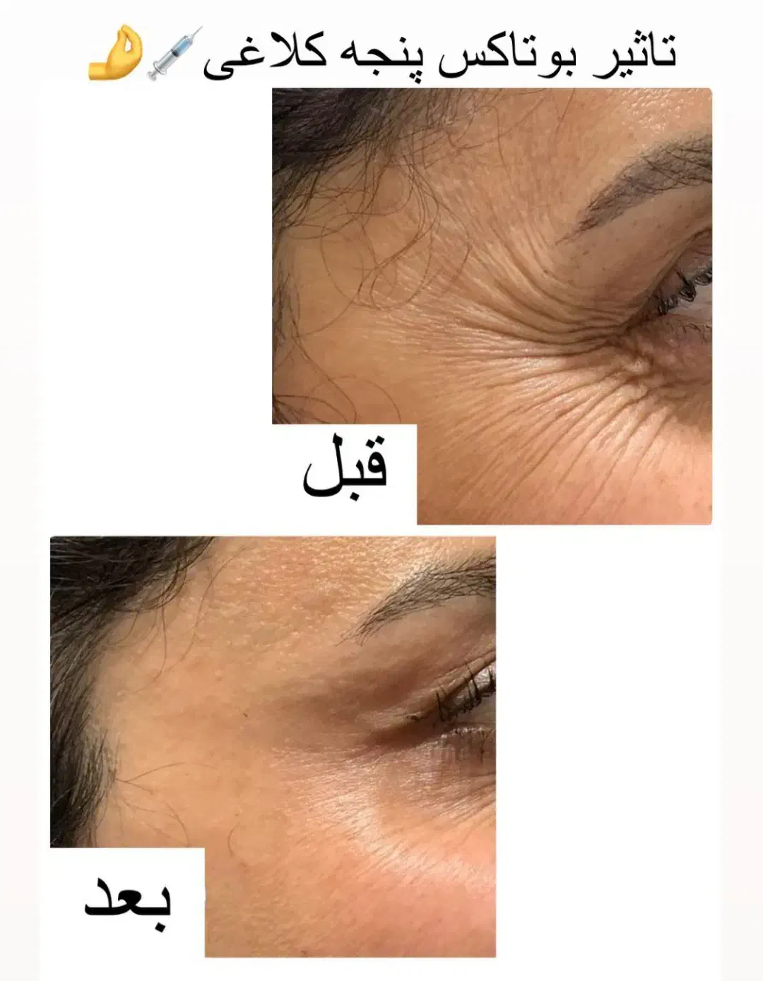 خدمات ژل بوتاکس آنزیم فیلر جوانساز مرو سر ابرو|خدمات آرایشگری و زیبایی|چهارباغ, |دیوار