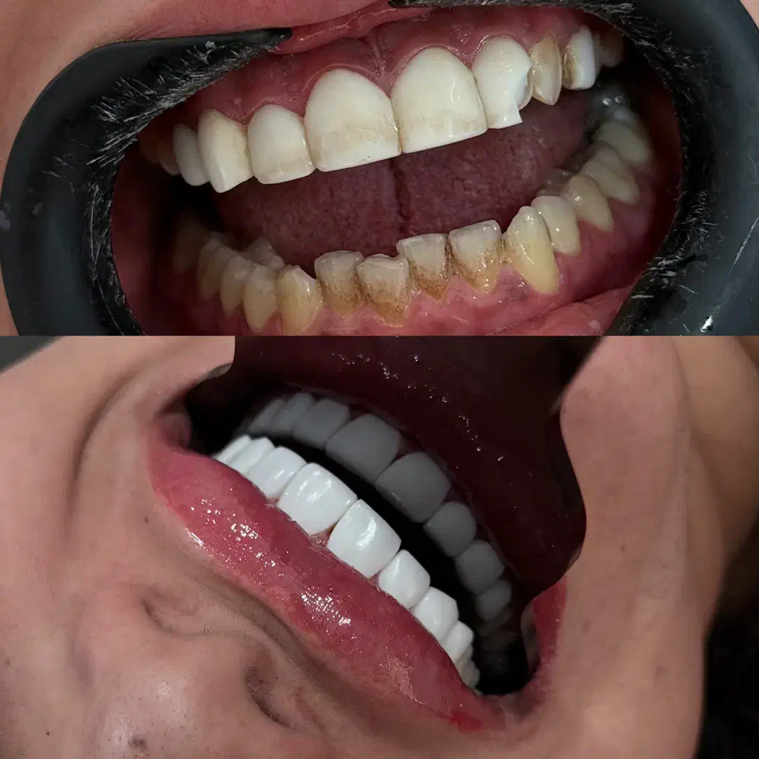 کامپوزیت دندان با برندهای معتبر جهانی|خدمات آرایشگری و زیبایی|اهواز, نادری|دیوار