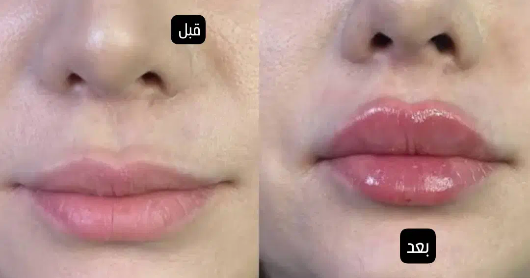 بوتاکس جوانساز آنزیم فیلر|خدمات آرایشگری و زیبایی|ملایر, |دیوار