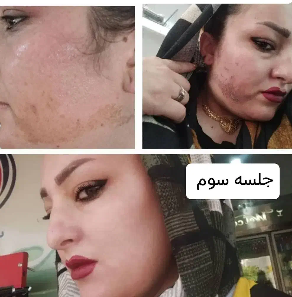 لیزرمو خانم300آقا600ریموتتوخال ژل بوتاکس لک پوستی|خدمات آرایشگری و زیبایی|نجف‌آباد, ویلاشهر|دیوار