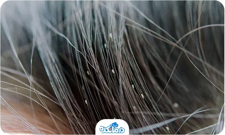 پاکسازی آنی و تضمینی مو از رشک و شپش با دستگاه|آرایشی، بهداشتی، درمانی|سبزوار, گلشن|دیوار