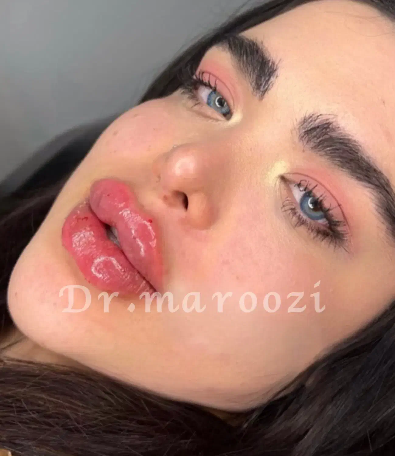 ژل لب فیلر بوتاکس مزو مادلینگ آنزیم بینی لیفتMD|خدمات آرایشگری و زیبایی|تهران, سردارجنگل|دیوار