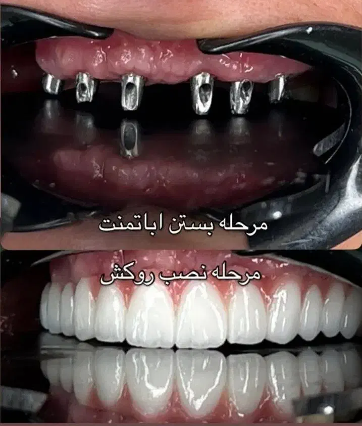 مرکز تخصصی دندانپزشکی ایمپلنت آلمانی(اقساط ۱۲ماهه)|خدمات آرایشگری و زیبایی|تبریز, |دیوار