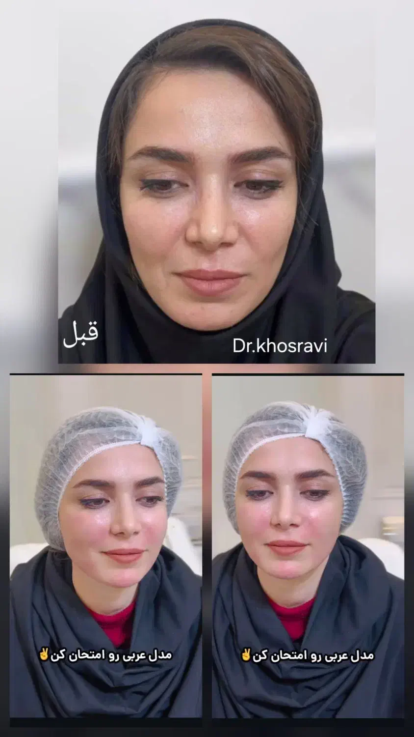 آف ویژه تزریق ژل و بوتاکس|خدمات آرایشگری و زیبایی|یاسوج, |دیوار