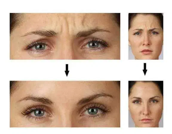 جوانی دوباره با تزریق بوتاکس تخصصی|خدمات آرایشگری و زیبایی|مشگین شهر, |دیوار