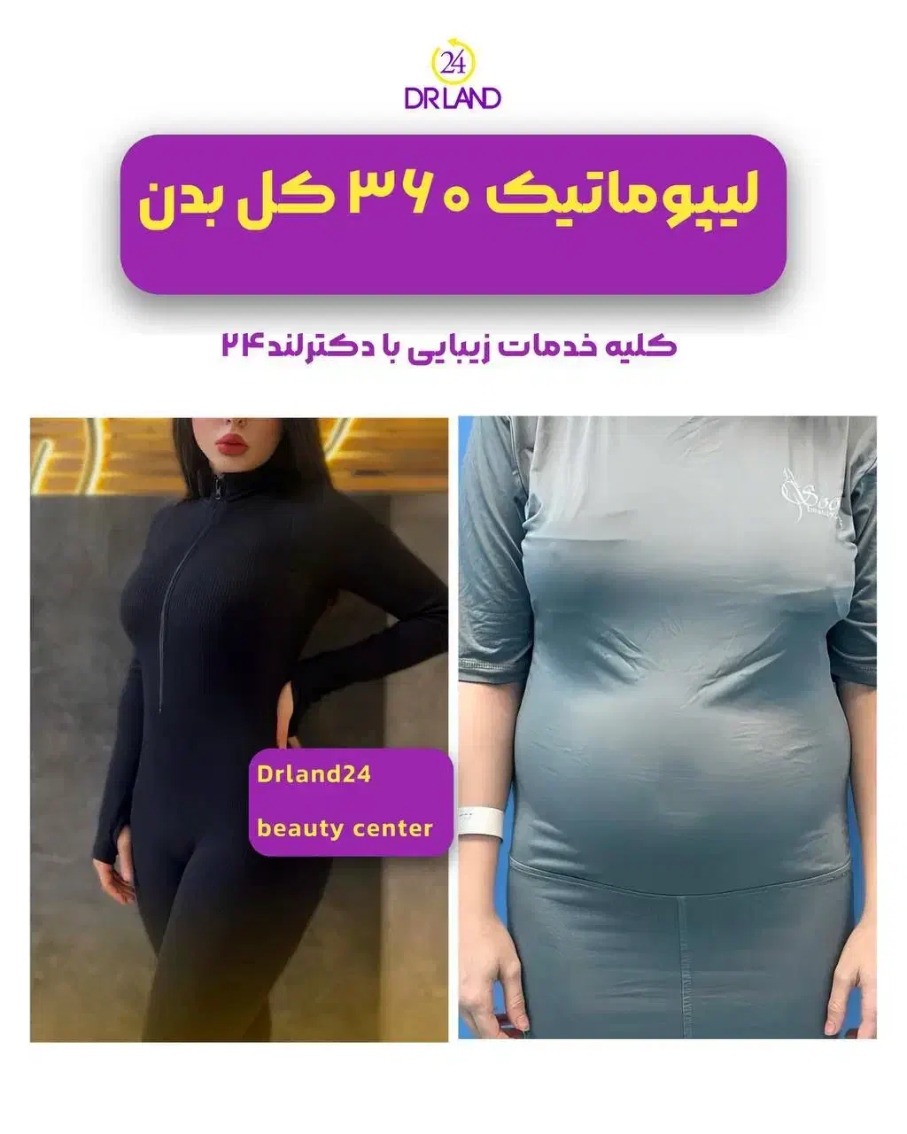 لیپو شکم،ابدو،غبغب،ماموپلاستی،فیلر بادی پروتزسینه|خدمات آرایشگری و زیبایی|شیراز, معالی‌آباد|دیوار