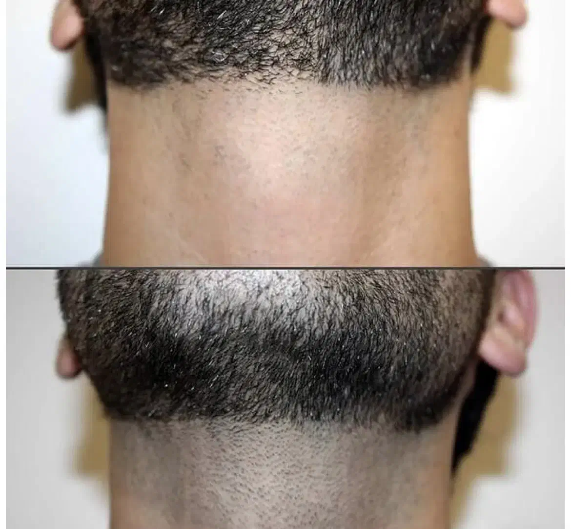 لیزر آقایان و بانوان|خدمات آرایشگری و زیبایی|تبریز, |دیوار