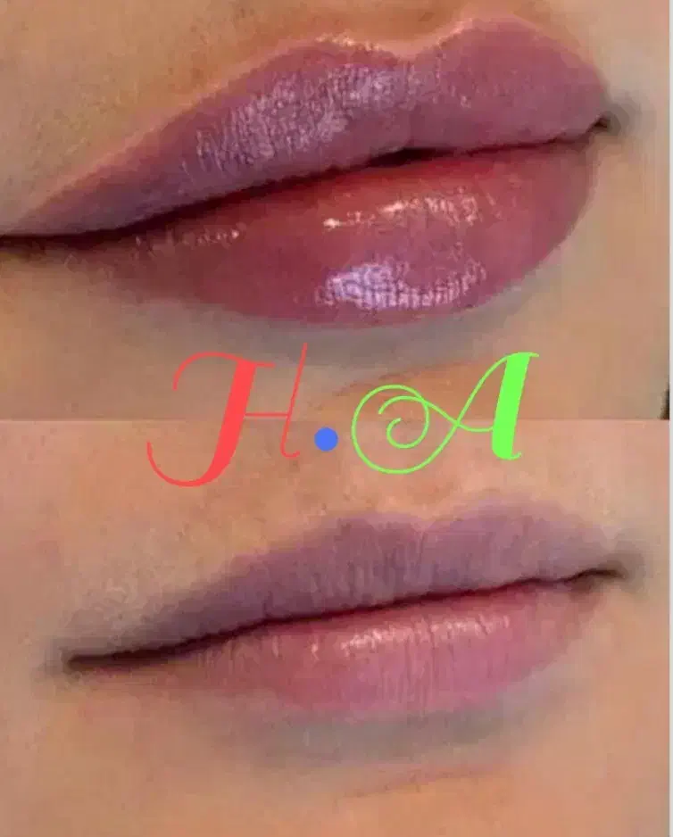 جشنواره ژل و بوتاکس درکلینیک پوست ومو|خدمات آرایشگری و زیبایی|شاهینشهر, فردوسی|دیوار