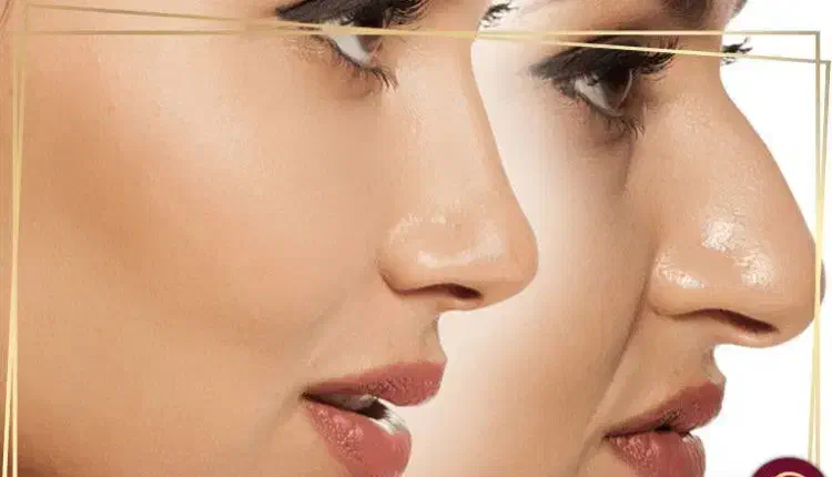 پروتز باسن/سینه تضمینی/ساکشن/غبغب اقساطی|خدمات آرایشگری و زیبایی|تهران, شهرک غرب|دیوار