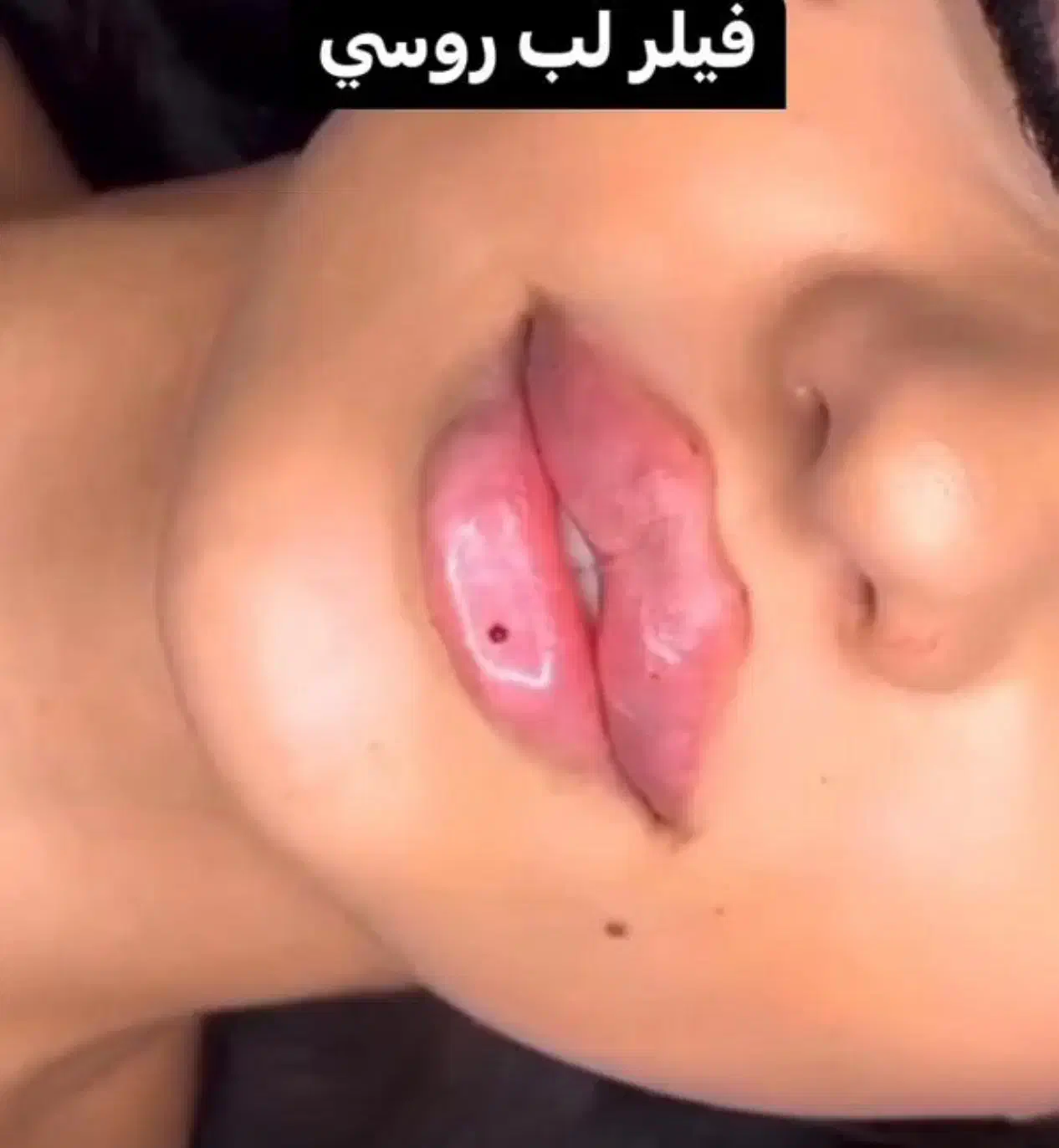 جشنواره ژل و بوتاکس و مزوژل|خدمات آرایشگری و زیبایی|تهران, ظفر|دیوار