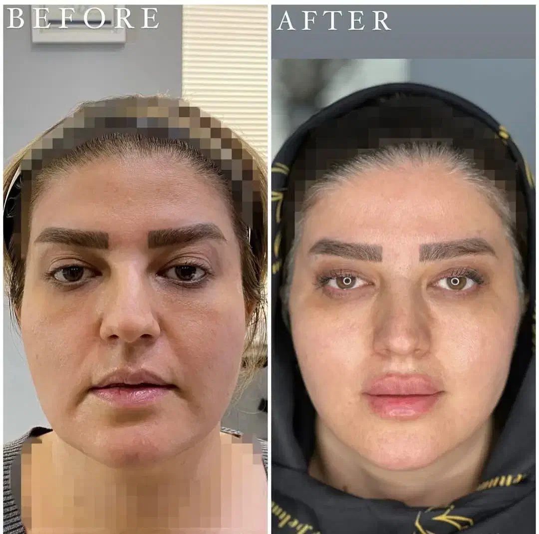 هایفو و جوانسازی پوست ویژه جشنواره یلدا ۸۹۰ت|خدمات آرایشگری و زیبایی|اصفهان, پروین|دیوار