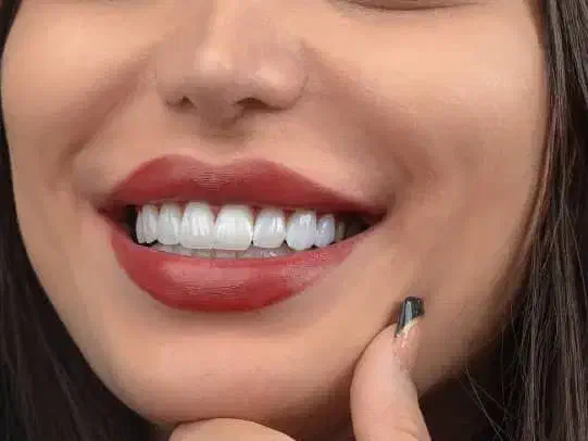 کامپوزیت دندان|خدمات آرایشگری و زیبایی|بروجرد, |دیوار