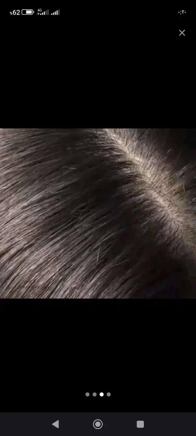 پایان کابوس شپش سر|آرایشی، بهداشتی، درمانی|آزادشهر, |دیوار