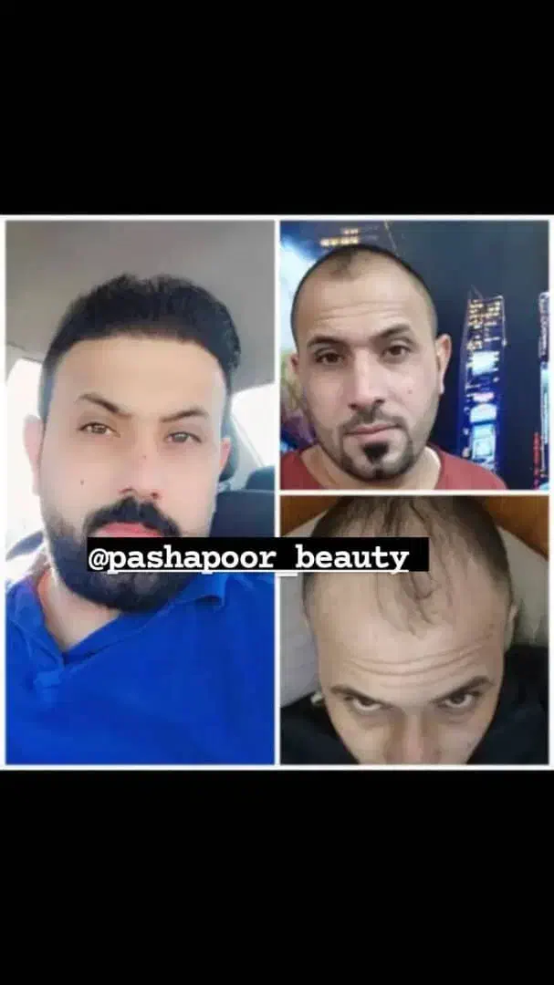 کاشت مو تخصصی|خدمات آرایشگری و زیبایی|پارس‌آباد, |دیوار