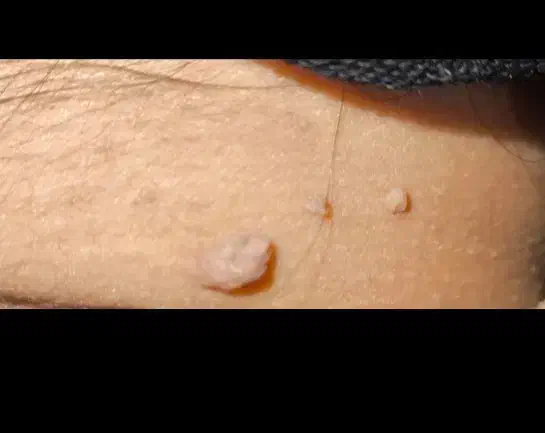 درمان خال گوشتی|آرایشی، بهداشتی، درمانی|کوهدشت, |دیوار