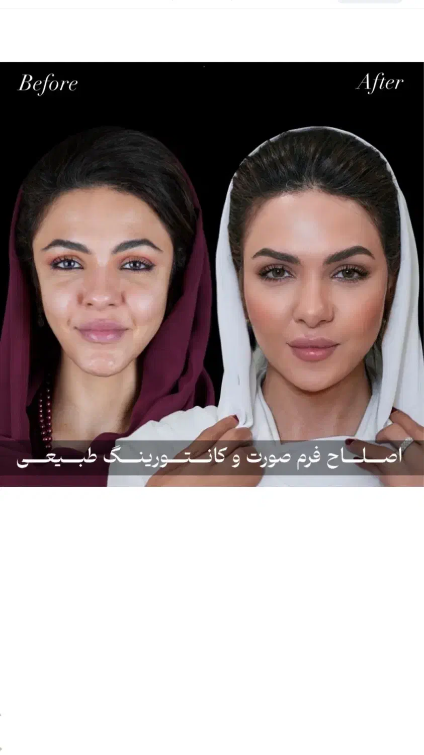 بوتاکس پیشانی،خط اخم رایگان شد توسط پزشک|خدمات آرایشگری و زیبایی|کاشان, بهشتی|دیوار