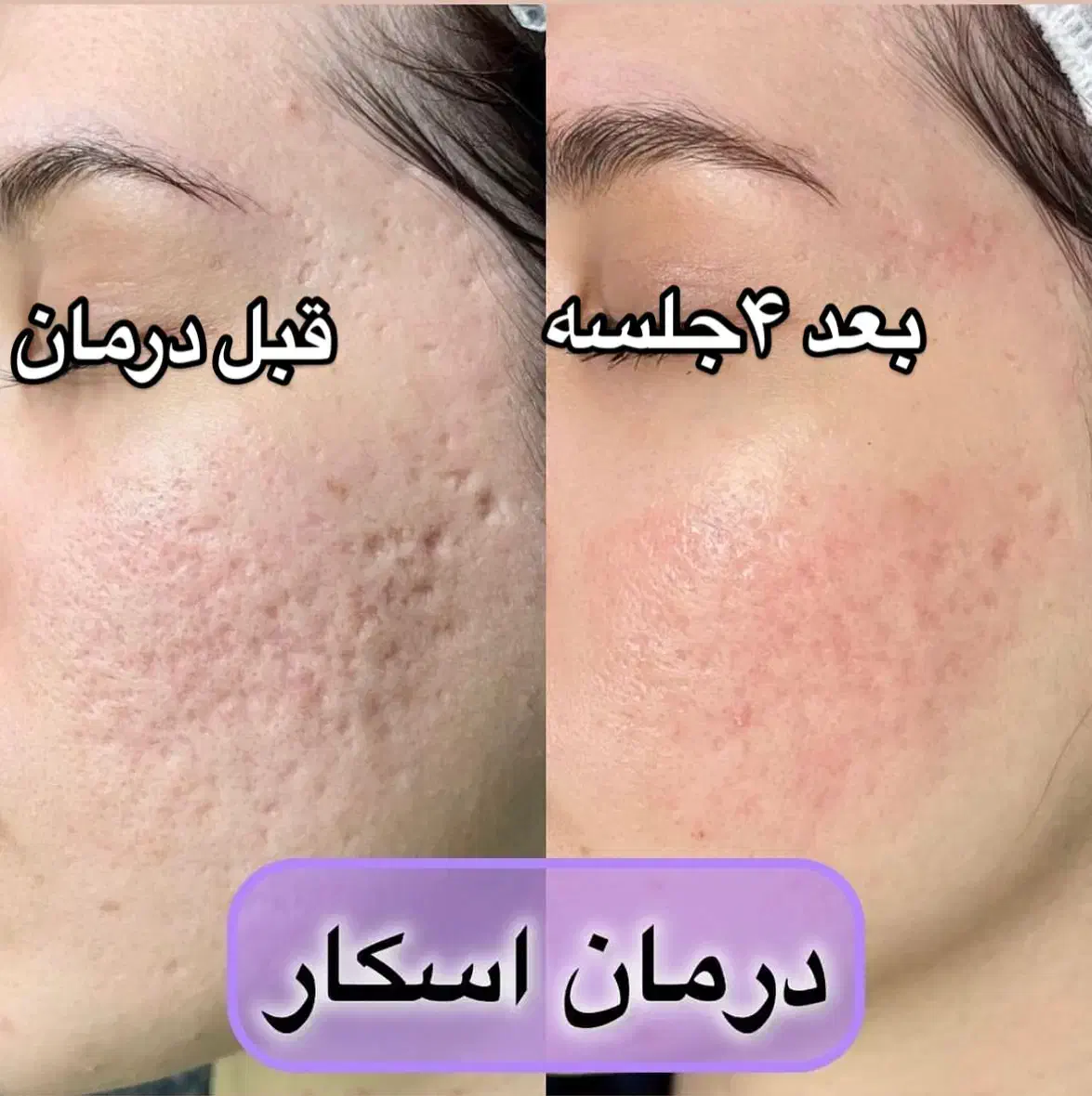مزونیدلینگ و مزوتراپی صورت و مو|خدمات آرایشگری و زیبایی|یاسوج, |دیوار