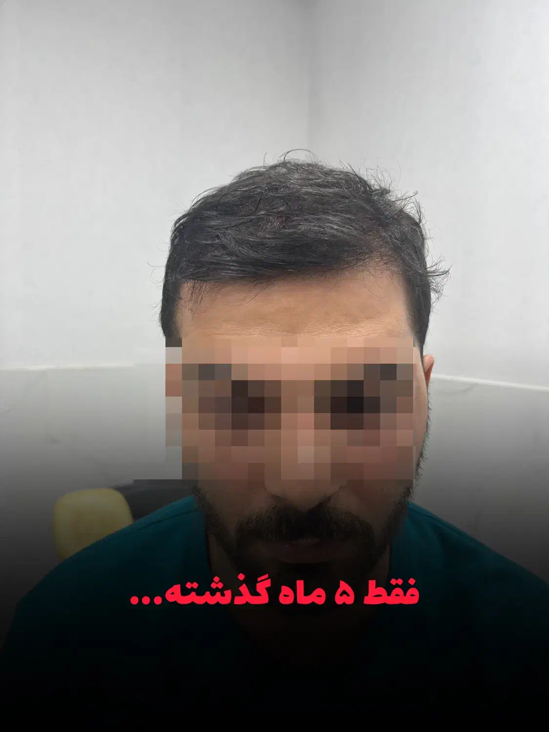 کاشت ابرو و مو با تیم تخصصی در کلینیک معتبر|خدمات آرایشگری و زیبایی|رشت, بوسار|دیوار