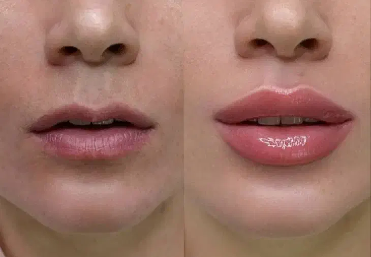 ژل فیلر بوتاکس مزو هایفو لیزر نخ|خدمات آرایشگری و زیبایی|اسلام‌شهر, باغ فیض|دیوار