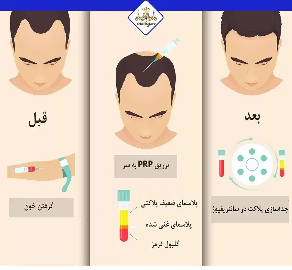 خدمات زیبایی درمنزلPRP دست صورت و مو|خدمات آرایشگری و زیبایی|رشت, خمیران زاهدان|دیوار
