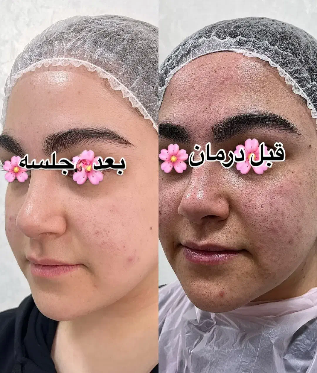 پاکسازی و فیشال /درمان جوش و لک و منافذباز|خدمات آرایشگری و زیبایی|کرمانشاه, |دیوار