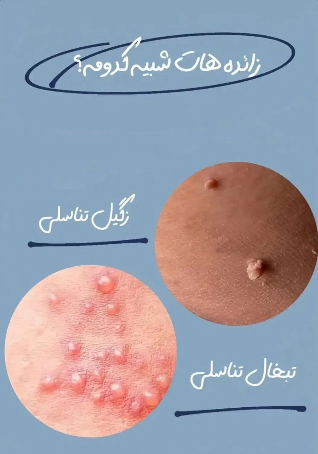 رفع دائمی زگیل و تبخال تناسلی|آرایشی، بهداشتی، درمانی|قزوین, |دیوار