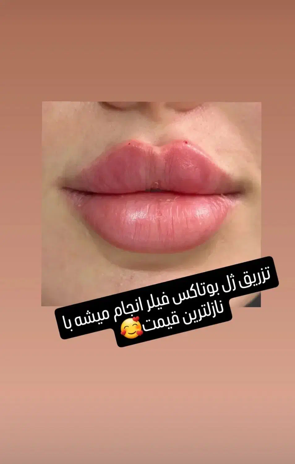 مدل برای ژل بوتاکس|خدمات آرایشگری و زیبایی|کوهدشت, |دیوار