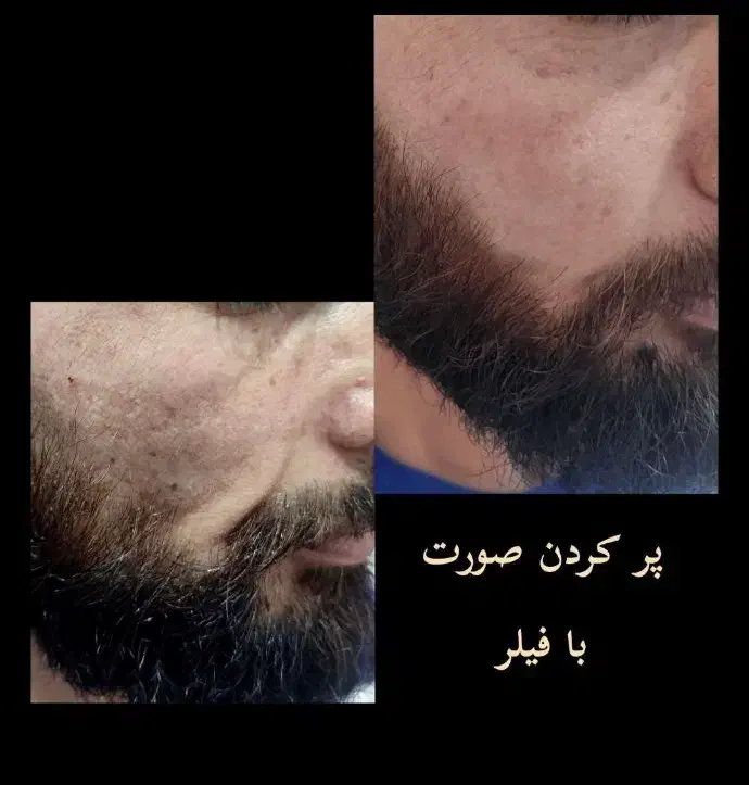 ویژه اقایان آف بوتاکس فیلر و پاکسازی|خدمات آرایشگری و زیبایی|کرج, گلشهر|دیوار