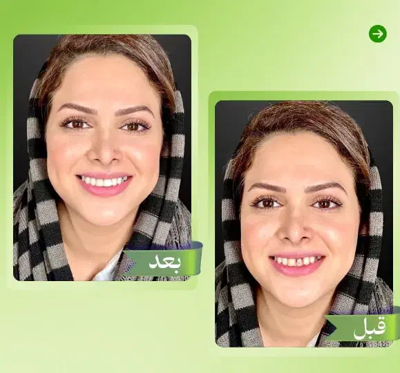 جشنواره ایمپلنت تاشب یلدافقط/۷۹۰۰|خدمات آرایشگری و زیبایی|نیریز, |دیوار