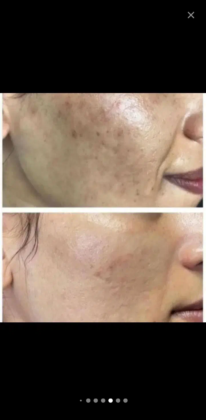 پاک کردن تتو با پیشرفته ترین لیزر کیوسوئیچ|خدمات آرایشگری و زیبایی|اهواز, کوی سعدی|دیوار