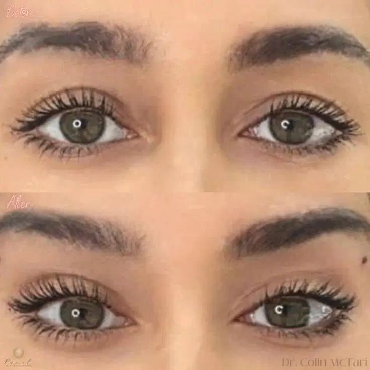 بلفارو پلک.لیفت تخصصی شقیقه ابرو صورت غبغب|خدمات زیبایی و سلامت|شیراز, معالی‌آباد|دیوار