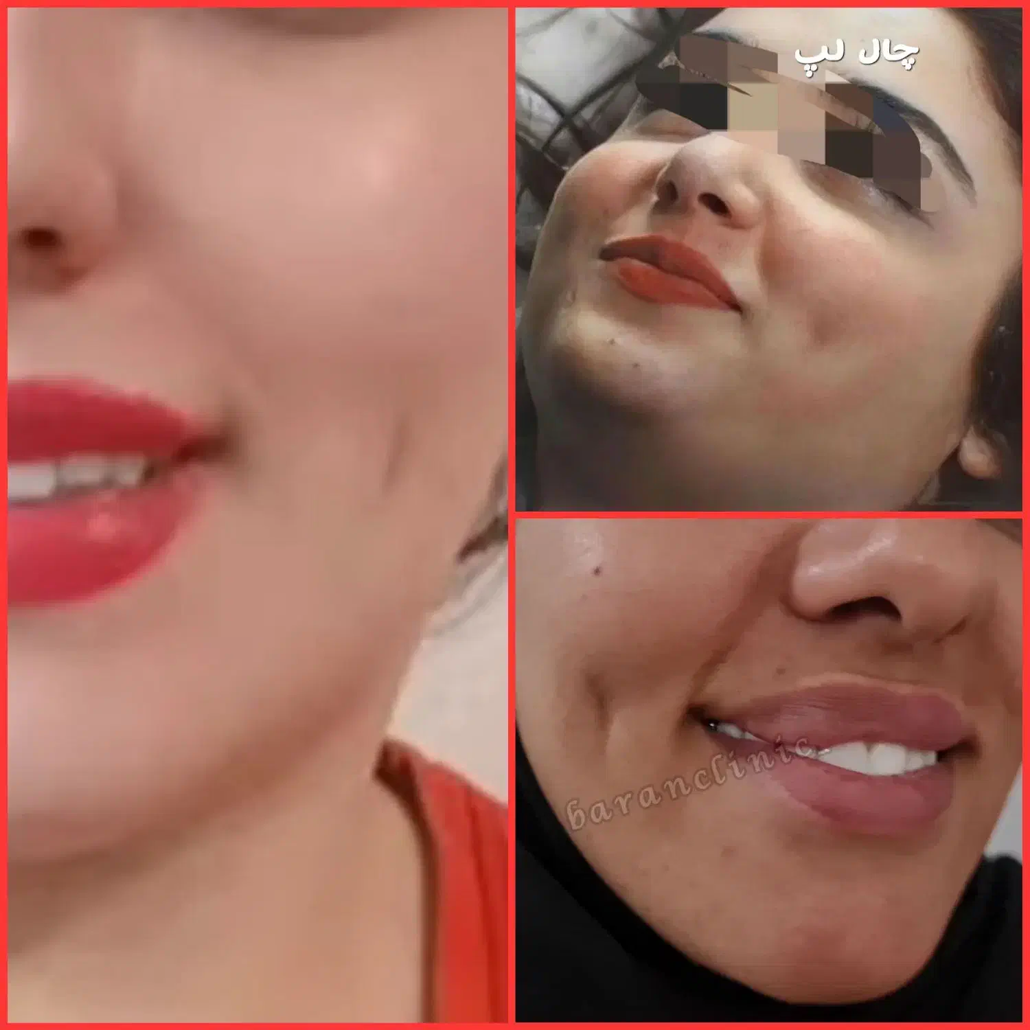 ژل بوتاکس چال لپ فیلربیکینی مزوتراپی پیرسینگ|خدمات آرایشگری و زیبایی|اسلام‌شهر, زرافشان|دیوار