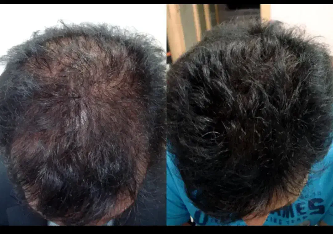 جشنواره یلدایی کاشت مو ، ابرو و مزوتراپی و prp|خدمات آرایشگری و زیبایی|زنجان, |دیوار