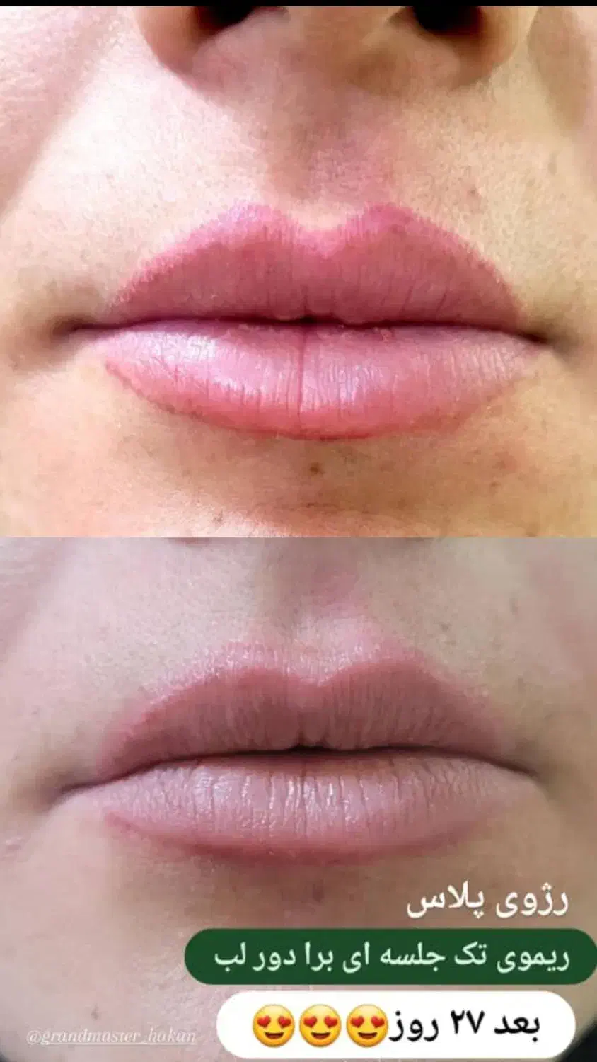 مدل فوری ریموو تتوی قدیمی وبدرنگ|خدمات آرایشگری و زیبایی|آمل, |دیوار