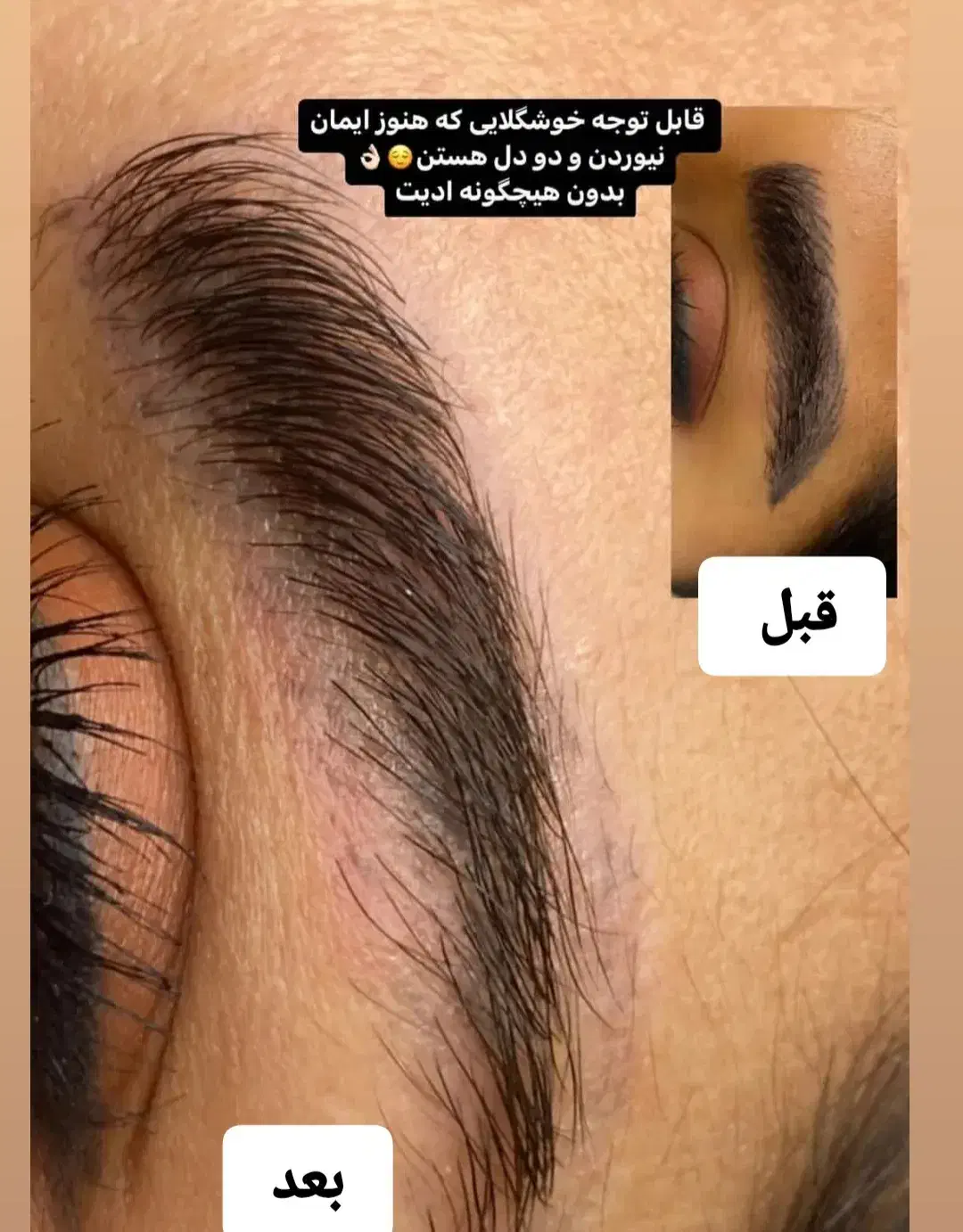 ریموو تک جلسه  با تخفیف ویژه|خدمات آرایشگری و زیبایی|تربت جام, پاسداران|دیوار