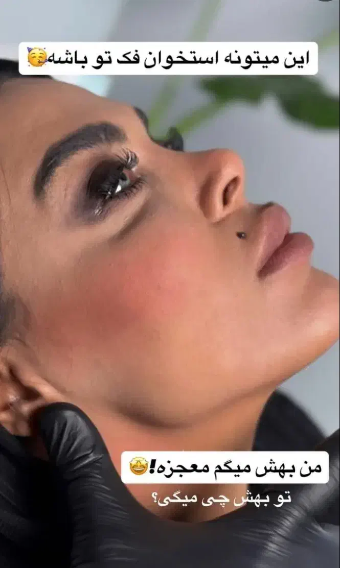 جشنواره پاییزی ژل و بوتاکس توسط پزشک|خدمات آرایشگری و زیبایی|کرمانشاه, |دیوار