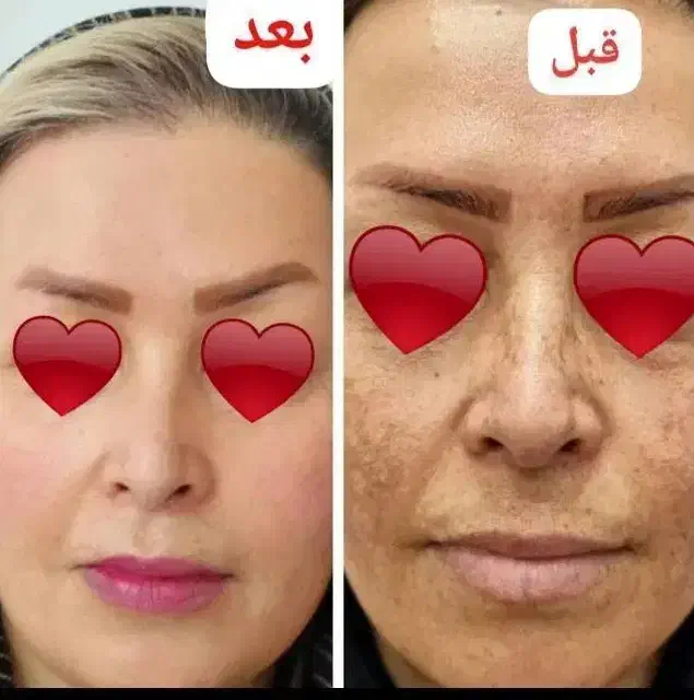 کرم VIP اماراتی معجزه صد درصد تضمینی|آرایشی، بهداشتی، درمانی|شیراز, مسلم|دیوار