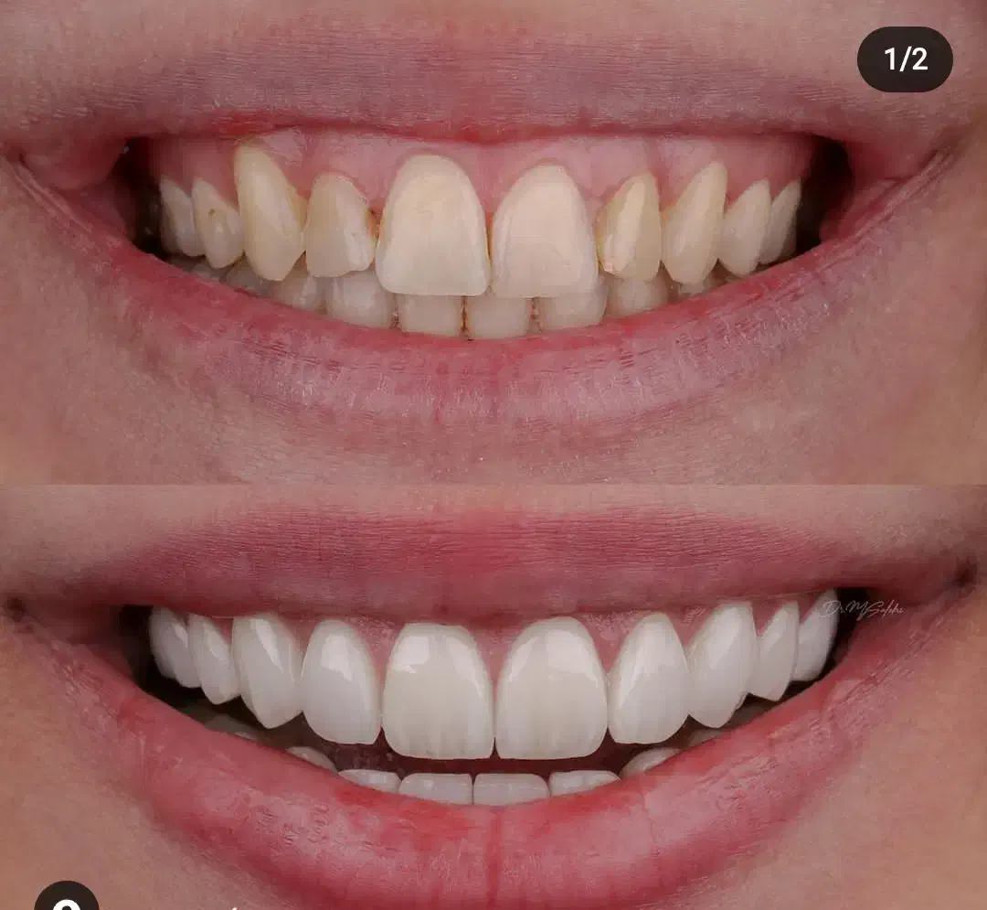 جشنواره کامپوزیت لمینت ، روکش|خدمات آرایشگری و زیبایی|تهران, دردشت|دیوار