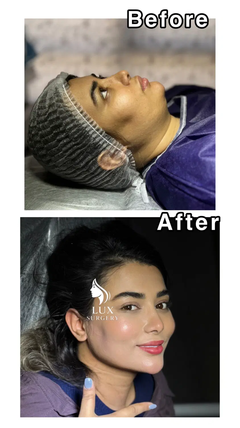 ساکشن غبغب با تکنیک وی لاین /صورت زاویه دار|خدمات زیبایی و سلامت|تهران, آرژانتین|دیوار