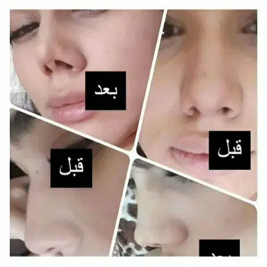 چسب لیفت بینی و شقیقه لوازم ارایشی|آرایشی، بهداشتی، درمانی|چناران, |دیوار