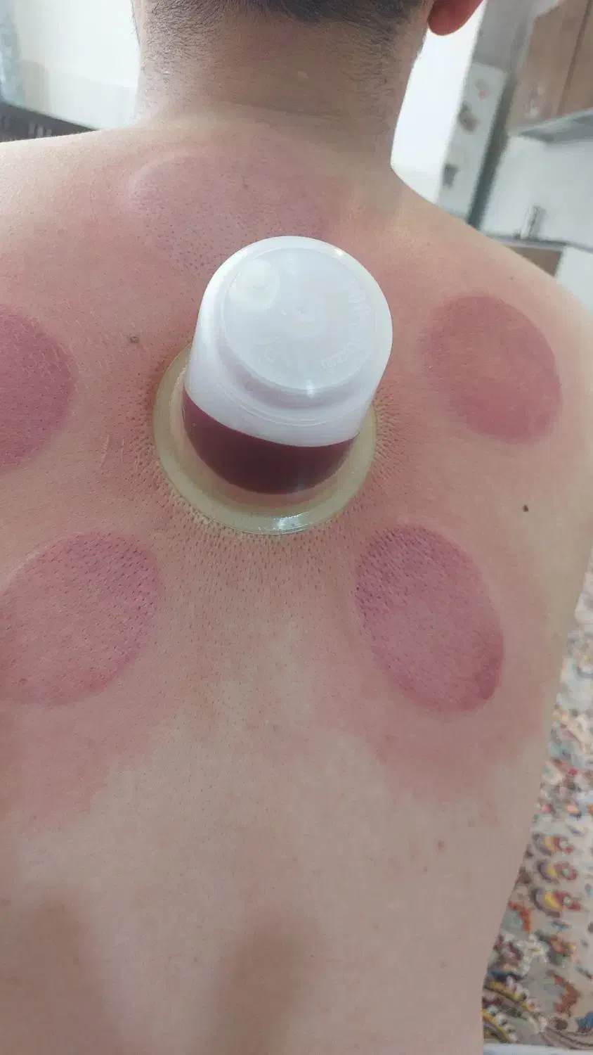 انجام انواع حجامت زالو درمانی بادکش درمانی|خدمات آرایشگری و زیبایی|زنجان, |دیوار