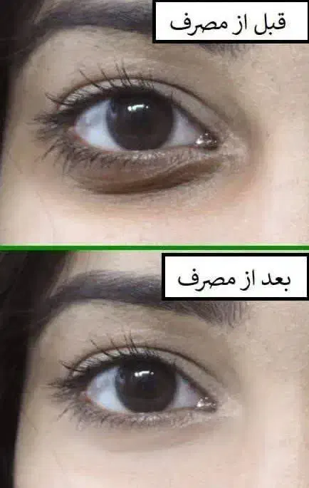 کرم دوره چشم گاتیو|آرایشی، بهداشتی، درمانی|رشت, بیجارپس|دیوار