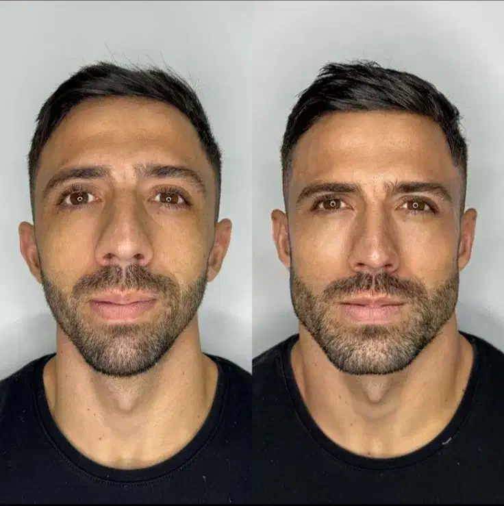 پزشک متخصص ژل و بوتاکس لیفت بانخ افزایش سایزآلت|خدمات آرایشگری و زیبایی|قم, صفائیه|دیوار