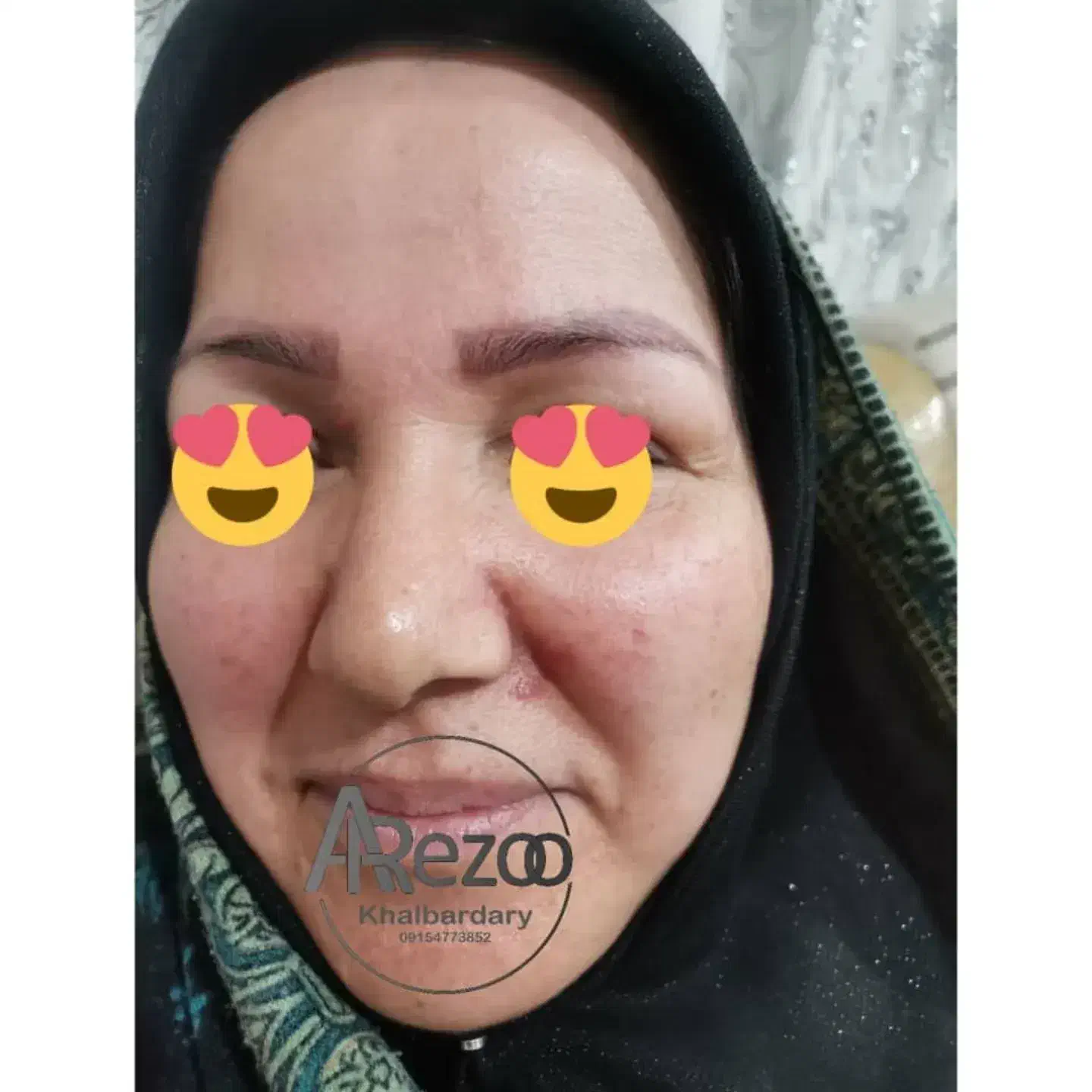 برداشتن خال و زگیل و کک مک و میخچه محلول تضمینی|خدمات آرایشگری و زیبایی|مشهد, شهرآرا|دیوار