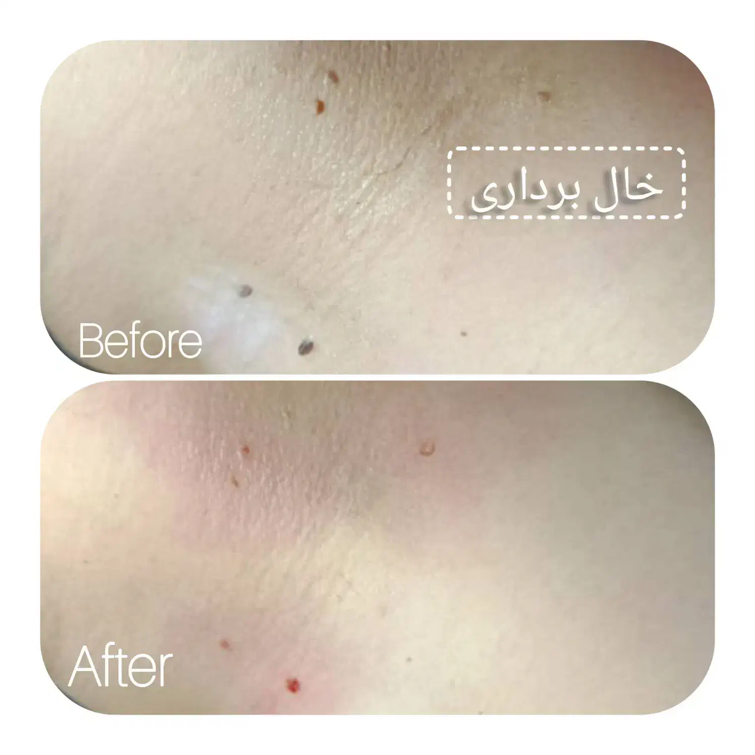 خدمات تزریق ژل و بوتاکس، خال برداری|خدمات آرایشگری و زیبایی|شیراز, حجت آباد|دیوار