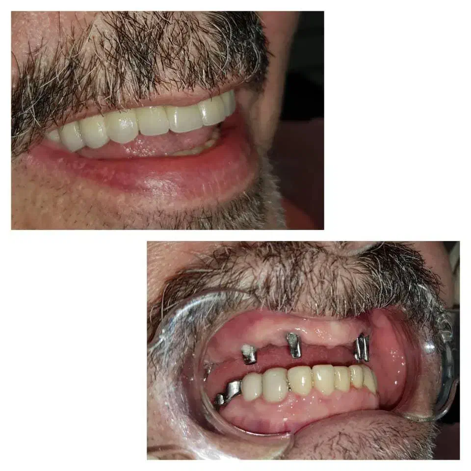 ایمپلنت اقساط بدون پول پیش تضمینی|خدمات آرایشگری و زیبایی|اصفهان, دشتستان|دیوار