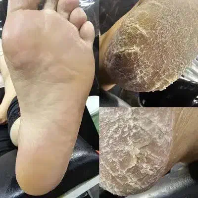 پدیکور تخصصی فشیال تخصصی موخوره گیری|خدمات آرایشگری و زیبایی|قم, کیوانفر|دیوار