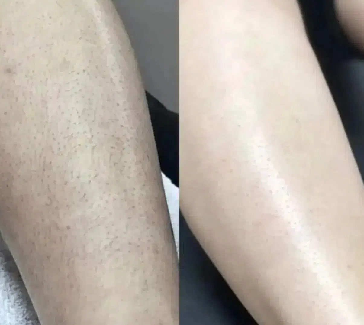 تخفیف لیزرموهای زائدبابهترین دستگاه سال|خدمات آرایشگری و زیبایی|بندرعباس, |دیوار